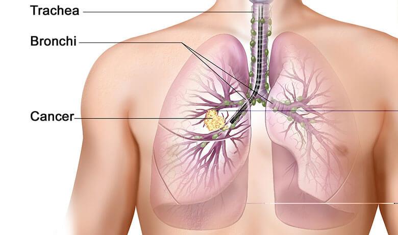 Ανάπτυξη καρκίνου πνεύμονα