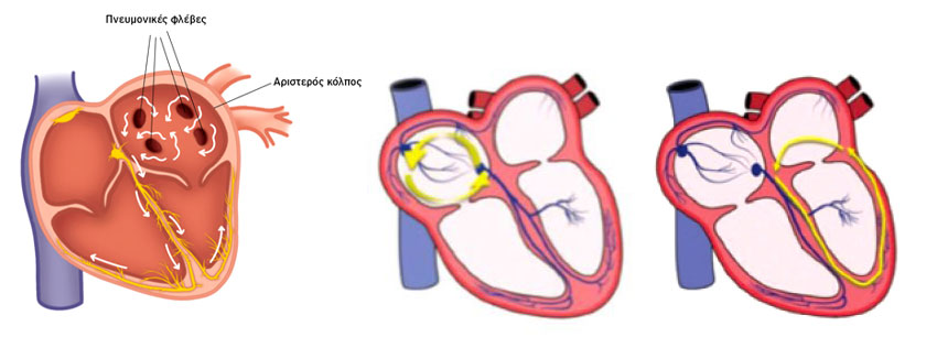 Κολπική μαρμαρυγή