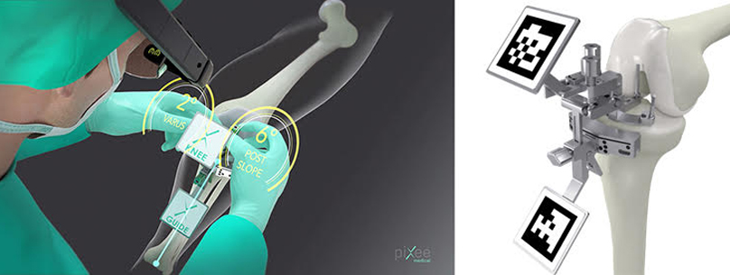 PIXEE ΚΝΕΕ+, σύστημα τεχνολογίας επαυξημένης πραγματικότητας για την ολική αρθροπλαστική γόνατος στο Metropolitan Hospital