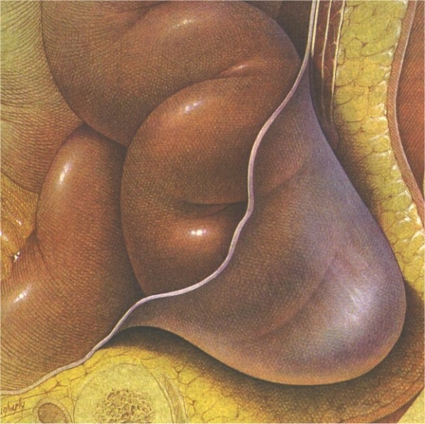 hernia2-16