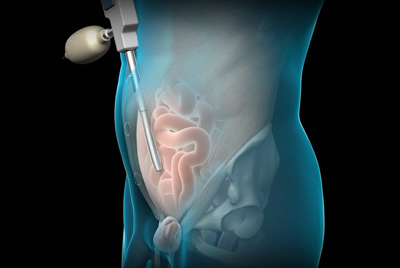 Λαπαροσκοπική e-TEP από τον Δρ. Δ. Θωμά