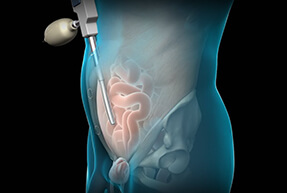 Λαπαροσκοπική e-TEP από τον Δρ. Δ. Θωμά