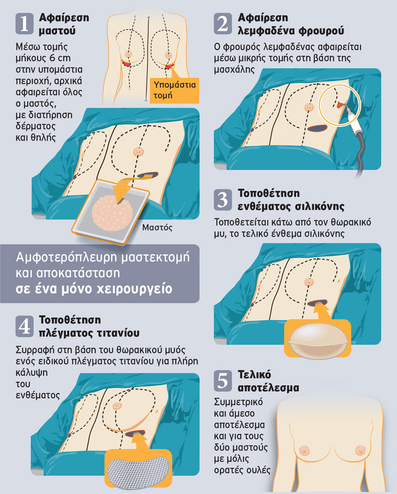 One Stage Technique:  πρωτοποριακή µέθοδος  άµεσης αποκατάστασης µε µία µόνο επέµβαση