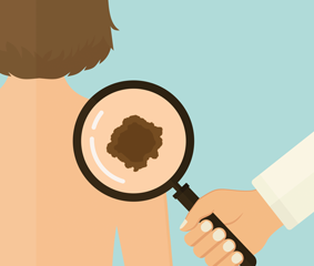 Απομονωμένη διάχυση άκρων με TNFα και μελφαλάνη για το προχωρημένο δερματικό μελάνωμα και σάρκωμα μαλακών μορίων.