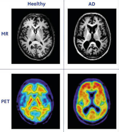 Απεικόνιση υγιούς και πάσχοντος από νόσο Alzheimer εγκεφάλου