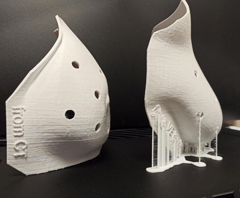 3D απεικόνιση και εκτύπωση στο Metropolitan Hospital:  προσομοίωση και εκτύπωση του αποτελέσματος μιας επέμβασης πριν αυτή γίνει