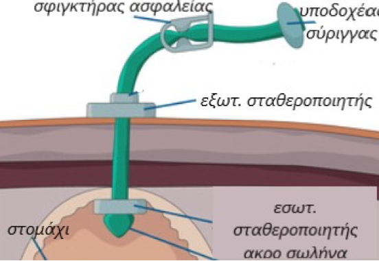 Διαγραμμα σωλήνα της γαστροστομίας