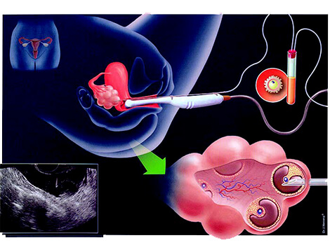 Διακολπική ανάκτηση ωοκυττάρων (transvaginal oocyte retrieval).