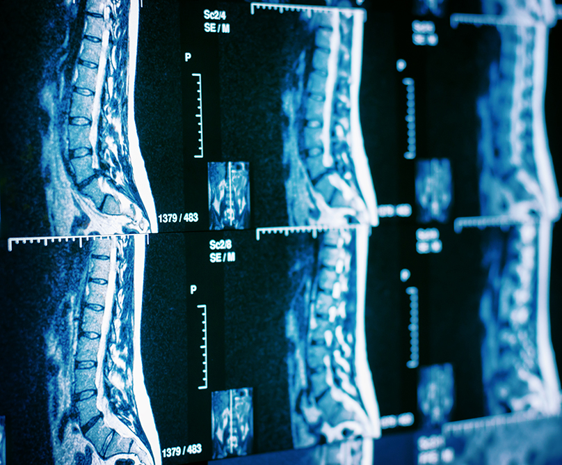 Πώς & γιατί η ρομποτική τεχνολογία κάνει ασφαλέστερη και αποτελεσματικότερη τη χειρουργική της σπονδυλικής στήλης;