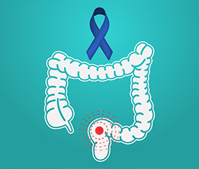 Σύγχρονες μέθοδοι αντιμετώπισης του καρκίνου του ορθού: Πώς αλλάζει η ζωή του ασθενούς
