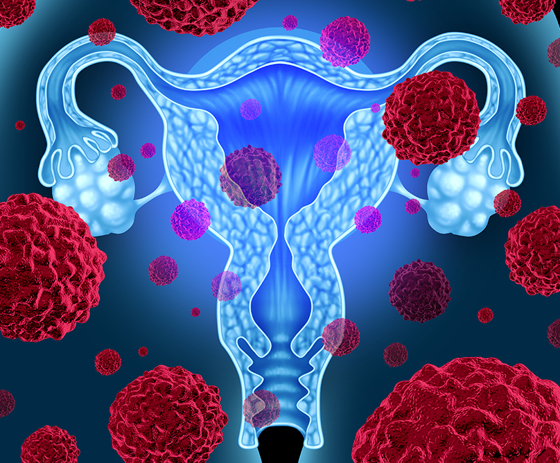 Καρκίνος του ενδομητρίου: τα νεότερα δεδομένα για τη μετάβαση στη χρονιότητα και την ίαση