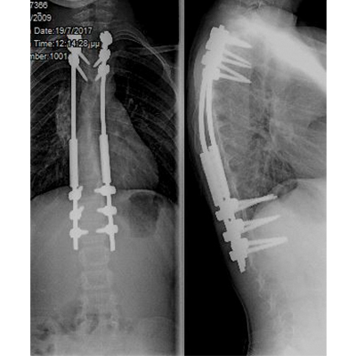 Διατεινόμενη σπονδυλοδεσία σε παιδική νευρομυϊκή σκολίωση