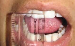 Περιορισμός διάνοιξης του στόματος ως αποτέλεσμα διαταραχής της ΚΓΔ