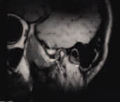 ΚΓΔ με κλειστό στόμα, όπου απεικονίζεται προσθίως παρεκτοπισμένος εκφυλισμένος διάρθριος δίσκοςοβελιαία