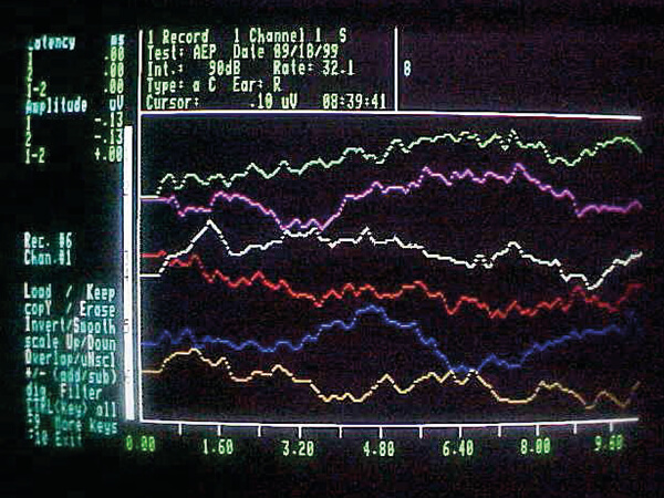 Αμφοτερόπλευρη κώφωση
