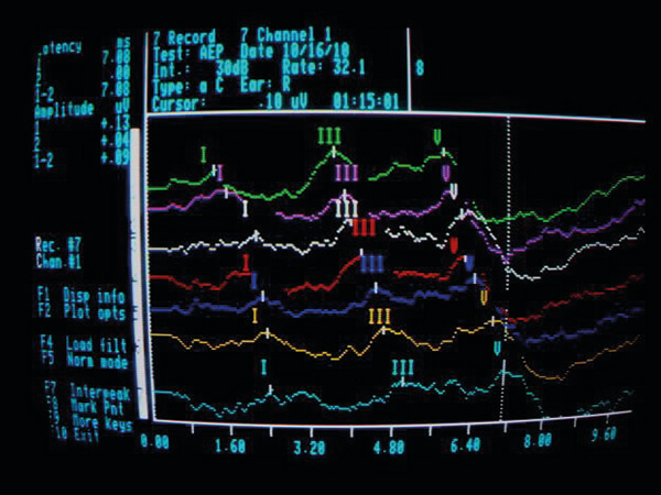 Φυσιολογικά Προκλητά Δυναμικά Εγκεφαλικού Στελέχους σε βρέφος