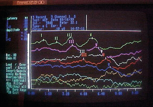 Μονόπλευρη κώφωση αριστερά. Δεξιά φυσιολογικό αυτί