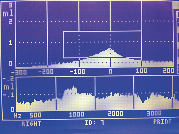Τυμπανόγραμμα Τύπου Α