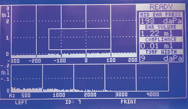 Τυμπανόγραμμα Τύπου Β
