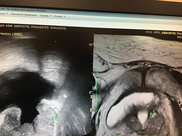 Μαγνητική Τομογραφία ηλικιωμένου άνδρα με διουρηθρική προστατεκτομή. Μαγνητική Τομογραφία ηλικιωμένου άνδρα με διουρηθρική προστατεκτομή.