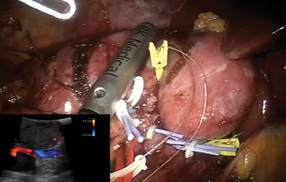 Ελάχιστα επεμβατική χειρουργική παρέμβαση