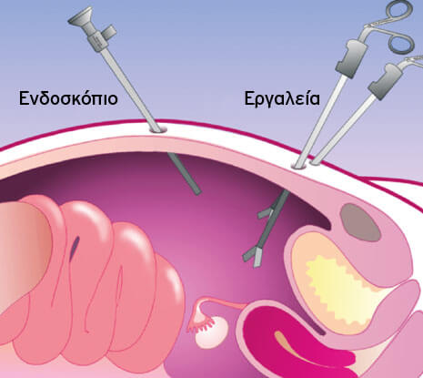 Ελάχιστα επεμβατική χειρουργική για τη γυναίκα