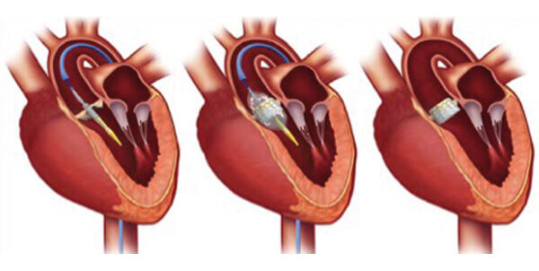 Διαδερμική αντικατάσταση της αορτικής βαλβίδας (TAVI)