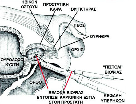 Εικόνα υπερηχογραφικά καθοδηγούμενης διορθικής βιοψίας προστάτη