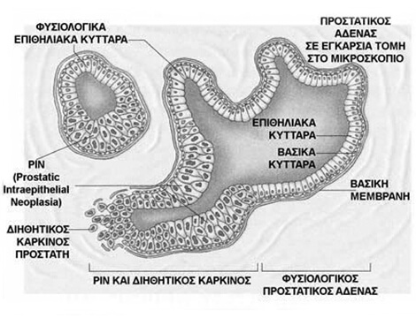 Παθολογοανατομική εικόνα εμφάνισης των αποτελεσμάτων μιας βιοψίας προστάτη