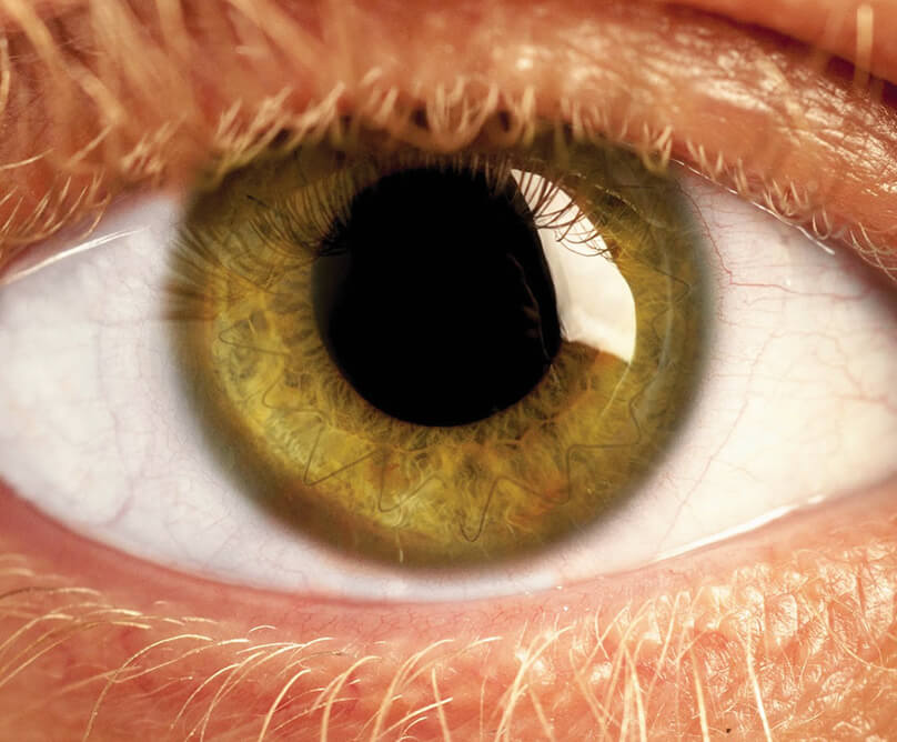 Μεταμόσχευση κερατοειδούς