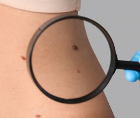 Πότε να μας  ανησυχήσει μια ελιά στο δέρμα
