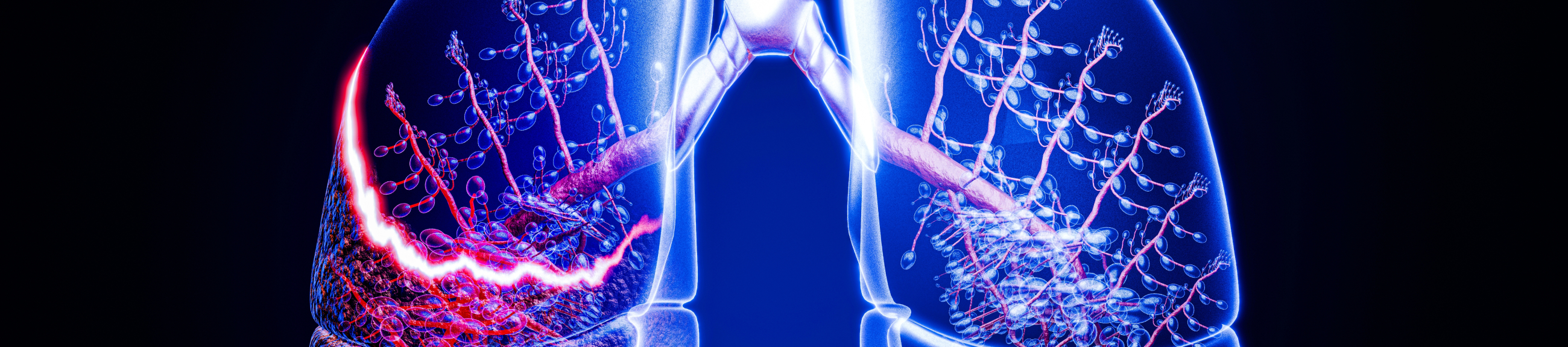 Θεραπεία του καρκίνου του πνεύμονα