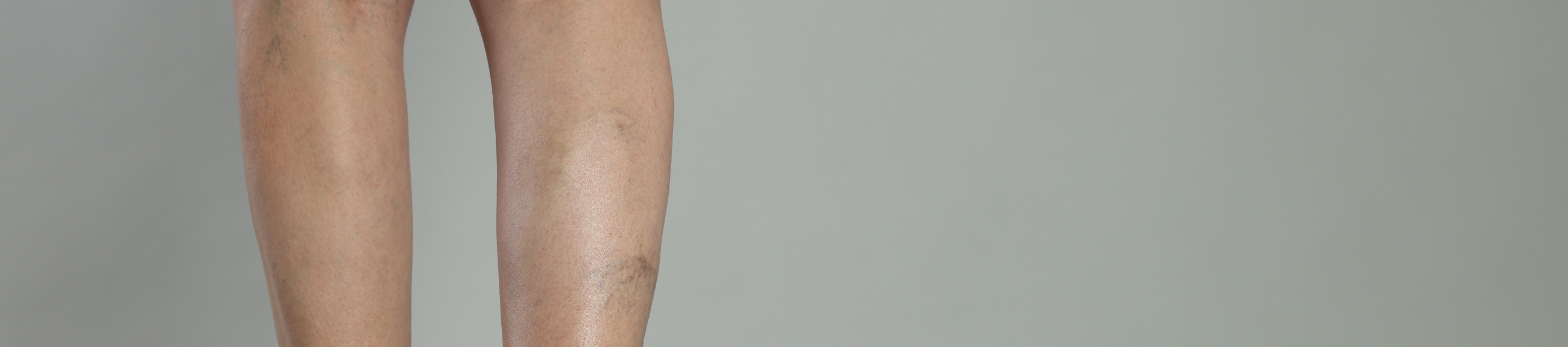 Κιρσοί και φλεβική ανεπάρκεια: το Metropolitan μπήκε στη «μεταlaser» εποχή