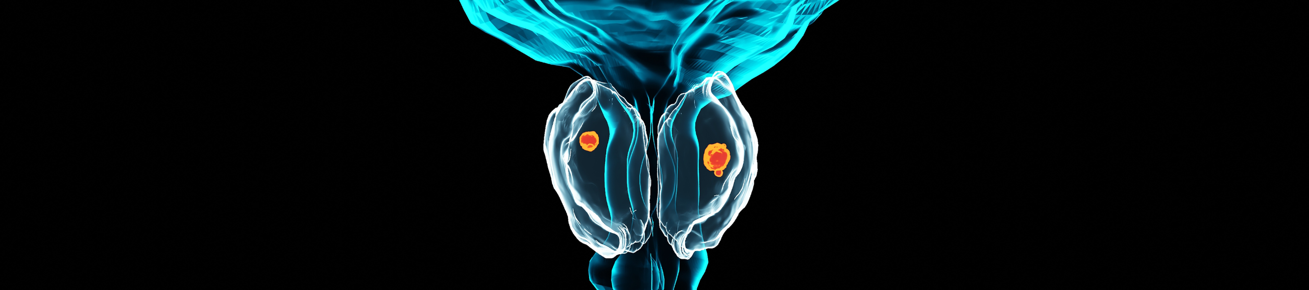 Καινοτόμο μαθηματικό μοντέλο πρόβλεψης του αποτελέσματος βιοψίας  προστάτη