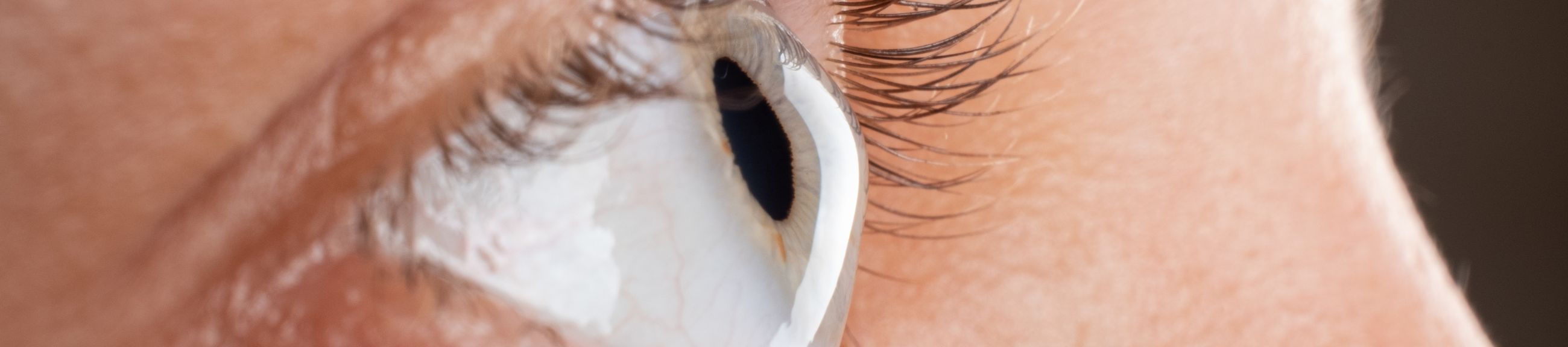 Οι επιπτώσεις του κερατοκώνου στην όραση και οι τρόποι αντιμετώπισης