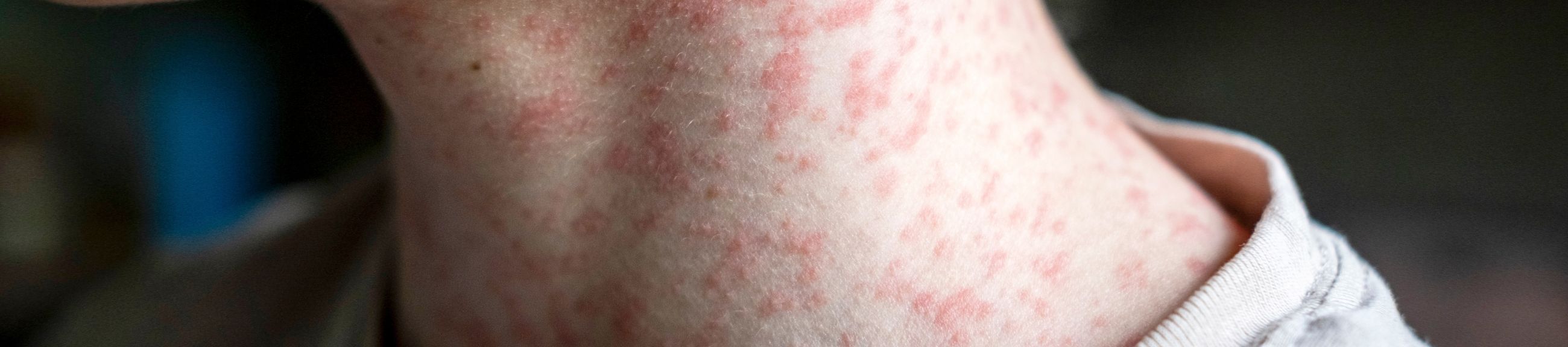 Ιλαρά, τότε και τώρα: η σημασία του εμβολιασμού και η επιδημία