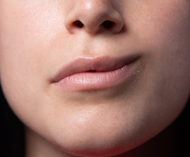 Παράλυση προσώπου