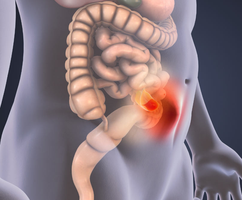 Ρομποτική θεραπεία κήλης: άψογο αποτέλεσμα, χωρίς σημάδια και ουλές