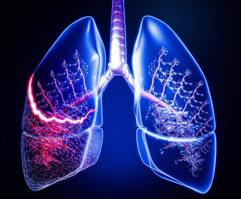 Θεραπεία του καρκίνου του πνεύμονα