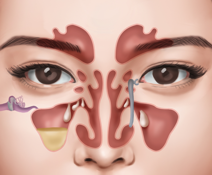 Ρινικοί πολύποδες: ο ρόλος της ενδοσκοπικής χειρουργικής στη σύγχρονη αντιμετώπισή τους