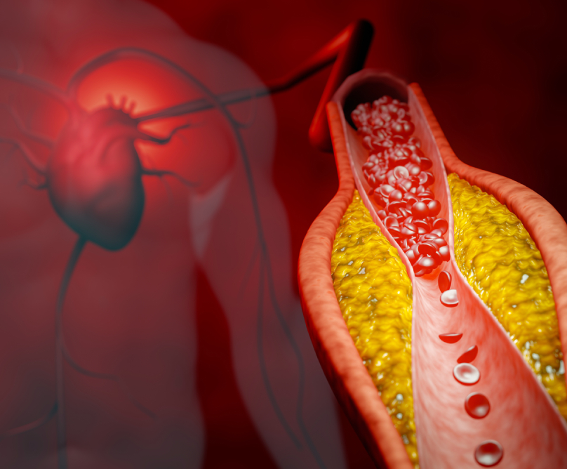 Ενδοστεφανιαία λιθοτριψία