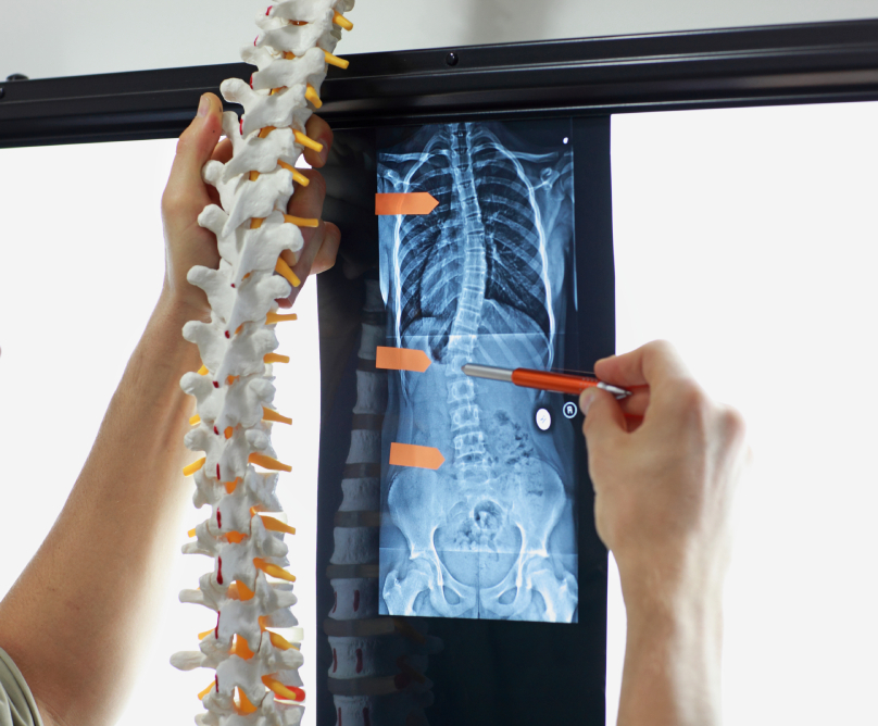 Σκολίωση και κύφωση: και αισθητικά και λειτουργικά ανώτερο αποτέλεσμα