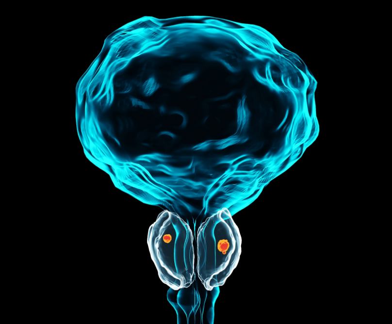 Καινοτόμο μαθηματικό μοντέλο πρόβλεψης του αποτελέσματος βιοψίας  προστάτη