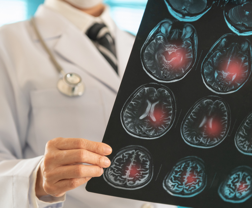 Ισχαιμικό εγκεφαλικό