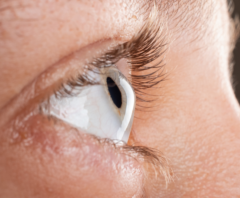 Οι επιπτώσεις του κερατοκώνου στην όραση και οι τρόποι αντιμετώπισης