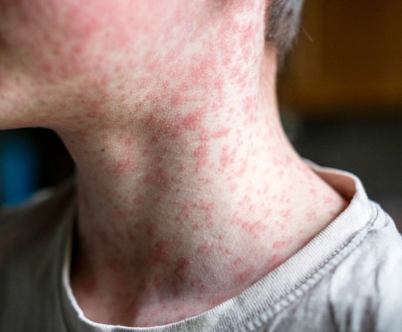 Ιλαρά, τότε και τώρα: η σημασία του εμβολιασμού και η επιδημία