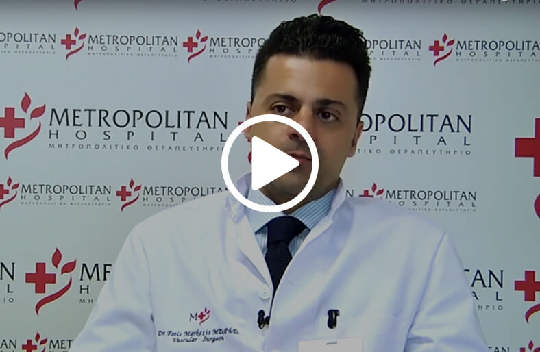 Αίσθημα κόπωσης και κιρσοί