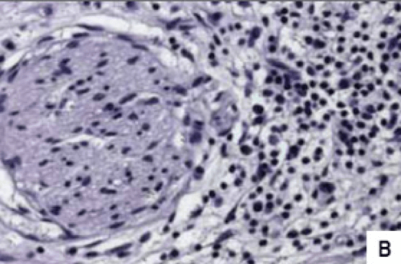 Φλεγμονώδη κύτταρα που διηθούν το πάγκρεας