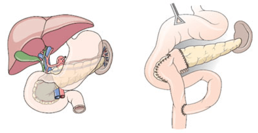 Εκτομή της κεφαλής του παγκρέατος με διατήρηση του δωδεκαδακτύλου
