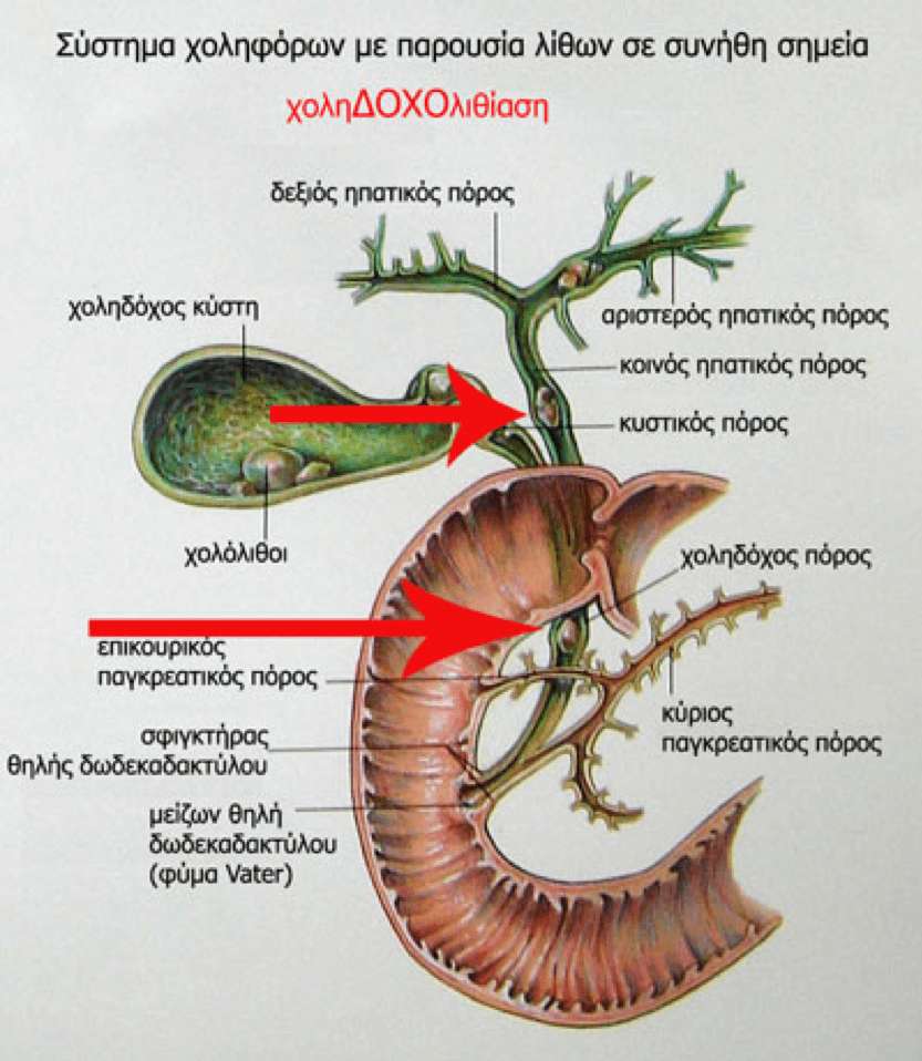 Σύστημα χοληφόρων με παρουσία λίθων σε συνήθη σημεία